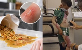 Bé 3 tuổi bị nước mì nóng đổ vào người, mẹ cứu con nhờ làm việc này