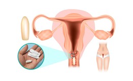 Vùng kín ngứa ngáy, đừng vội đặt thuốc nếu chưa biết điều này