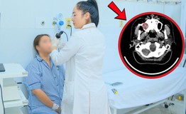 Đau đầu, chảy nước mũi suốt nhiều tháng, cô gái 24 tuổi sốc nặng khi đi khám