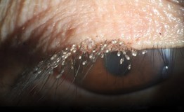 Ngứa mắt nhiều ngày, kinh hãi phát hiện hàng trăm con rận mu bám kín mi mắt