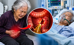 Tự thụt tháo vì táo bón, cụ bà 81 tuổi vỡ đại tràng, nguy kịch