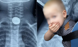 Bé 3 tuổi nuốt pin cúc áo, thực quản bị ăn mòn nghiêm trọng