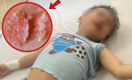 Bé trai 3 tuổi bị sùi mào gà trên mặt, 'thủ phạm' là thứ rất quen thuộc