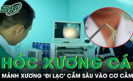 Phẫu thuật lấy xương cá 'trú ẩn' 10 ngày trong cằm bệnh nhân