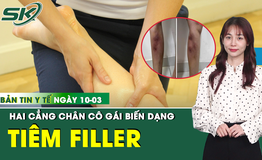 Bản Tin Y Tế 10/3: Tiêm filler để làm thẳng chân, cô gái 29 tuổi biến dạng cẳng chân