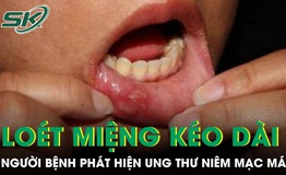 Loét miệng kéo dài, người bệnh phát hiện ung thư niêm mạc má