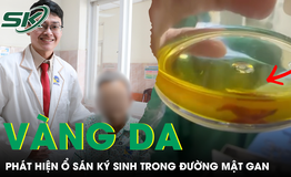 Vàng da, tắc mật do sán ký sinh trong đường mật gan