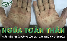 Ngứa toàn thân suốt 2 tháng, người đàn ông phát hiện nhiễm cùng lúc sán dây chó và giun đũa
