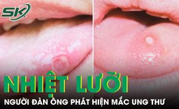 Người đàn ông phát hiện mắc ung thư từ dấu hiệu lạ ở lưỡi