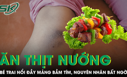 Bé trai nổi đầy mảng bầm tím sau bữa ăn thịt nướng, bác sĩ phát hiện nguyên nhân bất ngờ