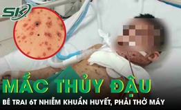 Biến chứng thủy đậu, bé trai 6 tuổi nhiễm khuẩn huyết, phải thở máy nguy kịch