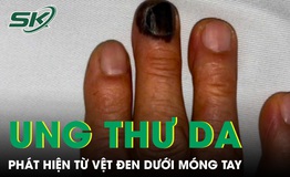 Bàng hoàng phát hiện ung thư da từ vệt đen dưới móng tay