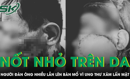 Chủ quan với nốt nhỏ trên da, người đàn ông nhiều lần phẫu thuật ung thư xâm lấn tái phát