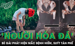 Bé gái cứng khớp suốt 2 năm sau cú ngã nhẹ, bác sĩ phát hiện mắc bệnh 'người hóa đá'