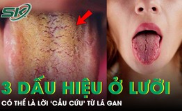 Đừng bỏ qua 3 dấu hiệu bất thường này trên lưỡi, có thể là lời 'cầu cứu' từ lá gan