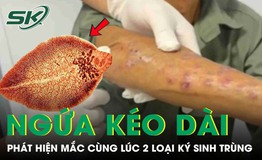 Người đàn ông tá hoả phát hiện mắc cùng lúc hai loại ký sinh trùng từ dấu hiệu ngứa kéo dài