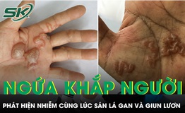 Ngứa khắp người nhiều tháng, bất ngờ phát hiện nhiễm cùng lúc sán lá gan và giun lươn 