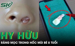 Răng mọc trong hốc mũi bé gái 8 tuổi