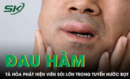 Đau hàm lâu ngày, người đàn ông tá hỏa phát hiện viên sỏi lớn trong tuyến nước bọt