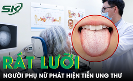 Rát lưỡi kéo dài, bất ngờ phát hiện tiền ung thư