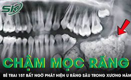 Răng nanh chậm mọc, bé trai bất ngờ phát hiện u răng sâu trong xương hàm