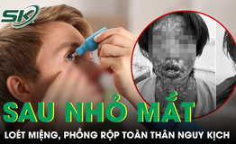 Loét miệng chảy máu, phồng rộp toàn thân nguy kịch sau khi tự dùng thuốc nhỏ mắt