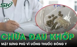 Mặt sưng phù vì uống thuốc đông y chữa đau khớp