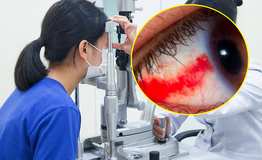 Bé gái 12 tuổi bị dây cáp quẹt vào mắt rách võng mạc