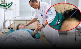 Bé gái 9 tuổi ngã xe đạp phải mở sọ cấp cứu 