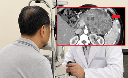 Đi khám vì mắt mờ, phát hiện khối u 5cm ở tụy
