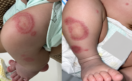 Em bé 26 ngày tuổi mắc lupus sơ sinh, khắp người xuất hiện mảng đỏ bất thường