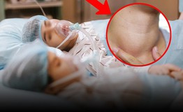 8 người một nhà cùng mắc một loại ung thư vì cổ to bất thường