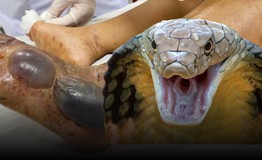 9 người bị rắn độc cắn may mắn thoát 'cửa tử' nhờ huyết thanh kháng nọc