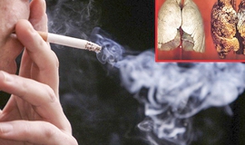 H&#250;t thuốc l&#225; chiếm đến 97% nguy&#234;n nh&#226;n g&#226;y ra ung thư phổi 