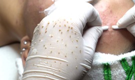 Nỗi đau kh&#244;ng thể ngờ sau khi nhiễm H từ một lần l&#224;m đẹp tại spa