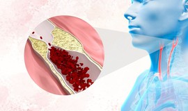 Hẹp động mạch cảnh có thể âm thầm báo trước một cơn đột quỵ