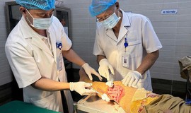 Ghép da tự thân phục hồi vận động cho bệnh nhân bỏng bô