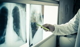 Bộ Y tế: Ưu tiên phân bổ ngân sách địa phương cho công tác phòng, chống lao