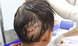 Bé 4 tuổi bị chó nhà cắn, nhiều vết thương nặng ở đầu và tay