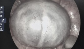 Chủ quan với cơn đau bụng, phát hiện u buồng trứng 14cm