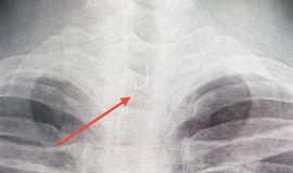 Sau ăn cá người đàn ông 46 tuổi bị mắc lưỡi câu sâu trong thực quản