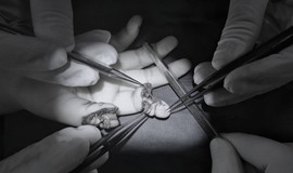 Bé 5 tuổi đứt rời 2 ngón tay khi chơi xe điện tự chế
