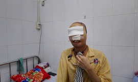 Hành trình 'làm lại gương mặt' cho chàng thanh niên mang di chứng bỏng suốt 3 năm