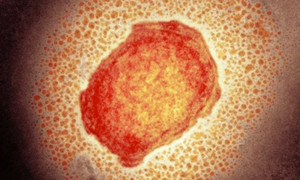 Bệnh đậu mùa khỉ: Virus gây bệnh nguy hiểm như thế nào?