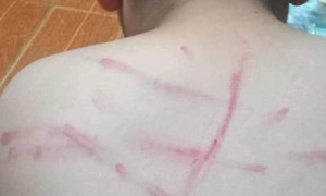 Không làm bài tập, một học sinh lớp 4 bị cô giáo đánh bầm tím lưng