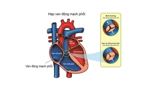 Thuốc n&#224;o điều trị hẹp van động mạch phổi?