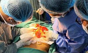 Việt kiều Mỹ 73 tuổi lựa chọn về Việt Nam phẫu thuật khối u đại tràng ác tính