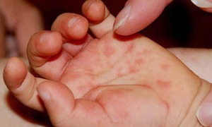 Số ca mắc tay ch&#226;n miệng tại TP. Hồ Ch&#237; Minh tăng mạnh, c&#225;ch n&#224;o ph&#242;ng ngừa cho trẻ?
