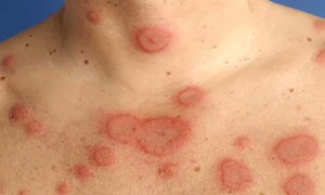 Phát hiện kịp thời trẻ mắc lupus ban đỏ hệ thống