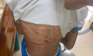 Xác minh thông tin bé gái nghi bị cha dượng bạo hành dã man